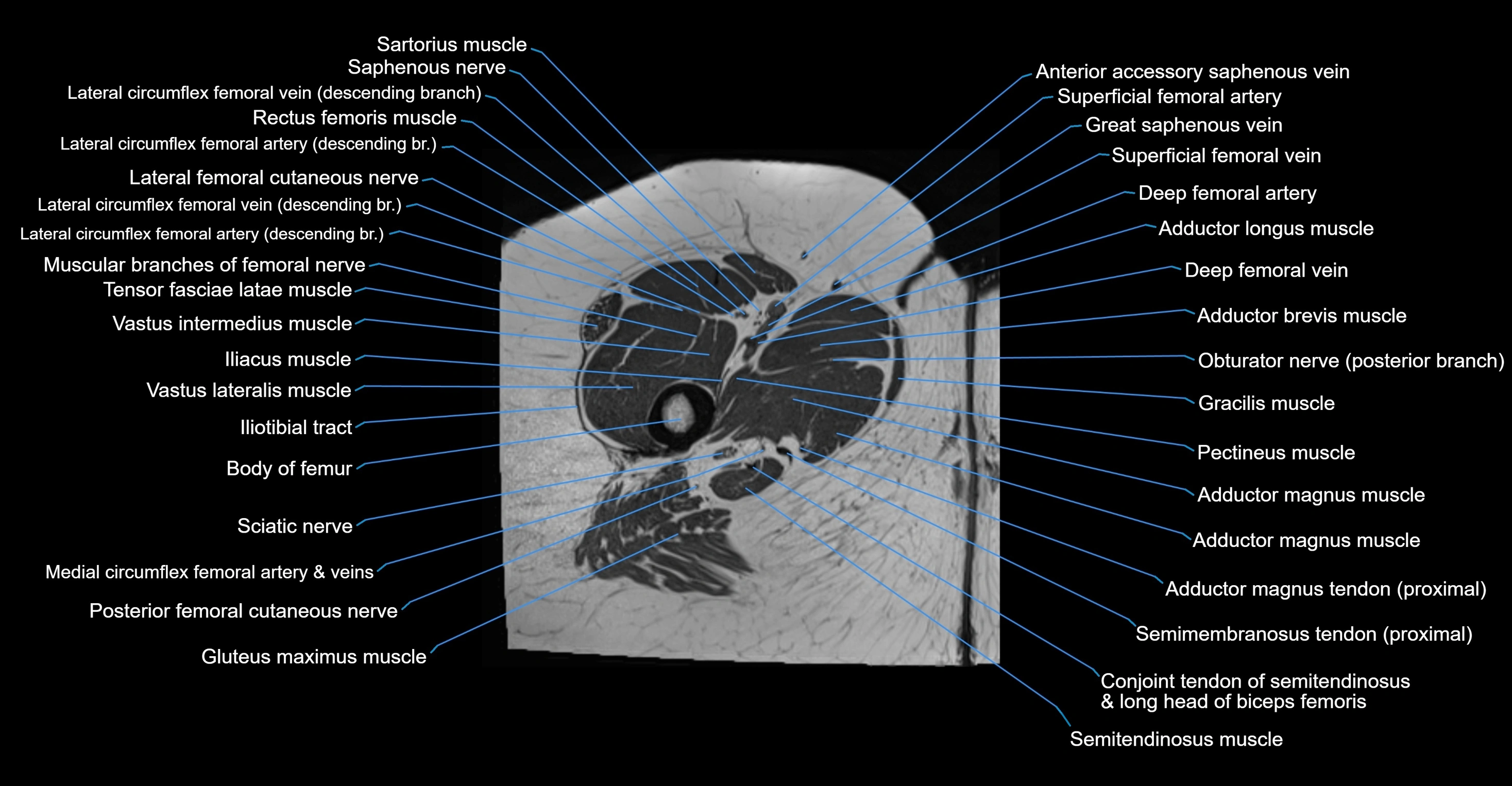 MRI hip axial cross sectional anatomy 3T 3D  radiology  anatomy image-img-00001-00085.webp